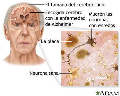 1 Alzheimer Glutation Immunocal